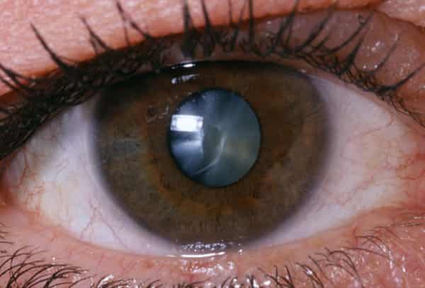cataract eye
