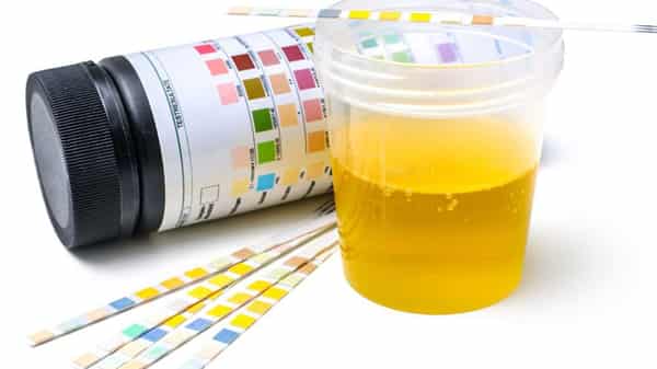 urinalysis