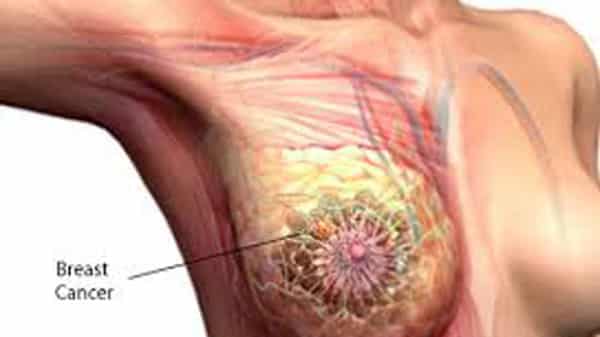 Breast-Cancer,-17-09-17