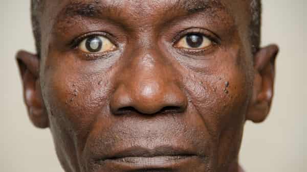 cataracts1 black blind man