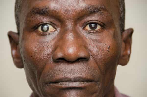 Glaucoma/Cataract. Photo Pinterest