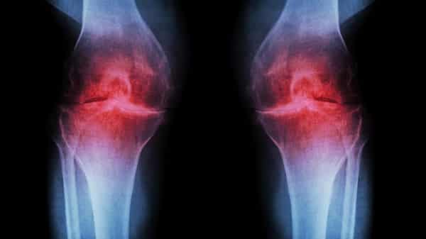 osteoarthritis