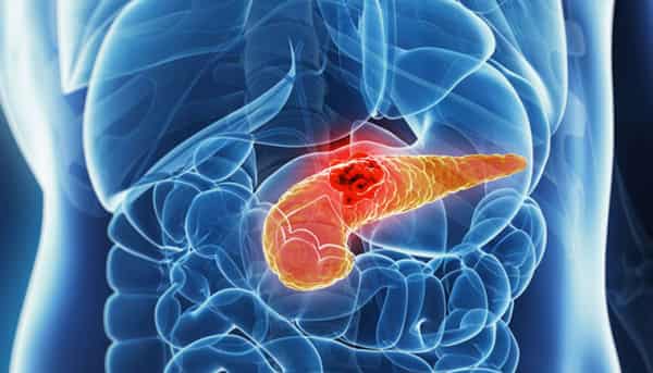 pancreatic-cancer