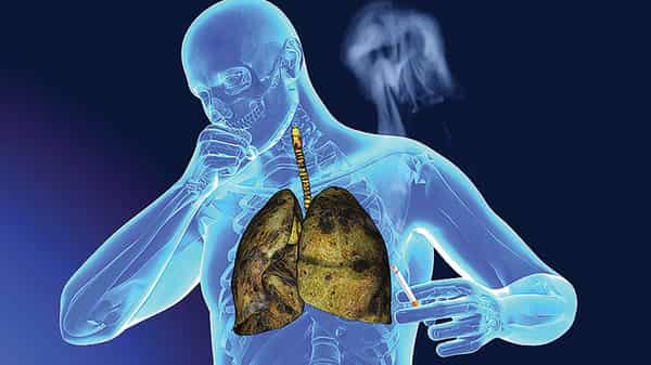 Lung-cancer–1