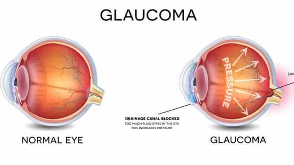 Glaucoma-pix