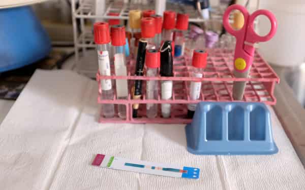 An HIV test shows a positive result at the lab of the NGO “Accion Solidaria” in Caracas
