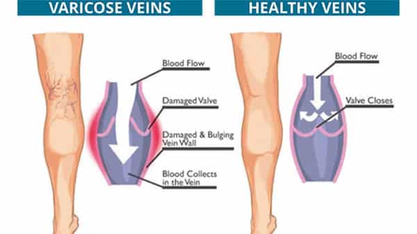 Varicose-veins