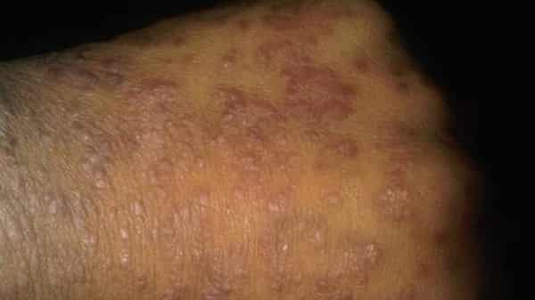 Psoriasis