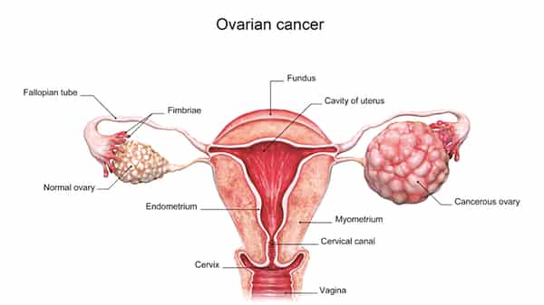 3d rendered ovarian cancer illustration.
