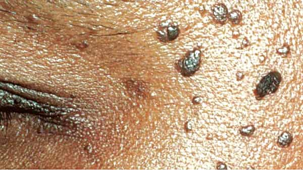 SKIN TAG 1