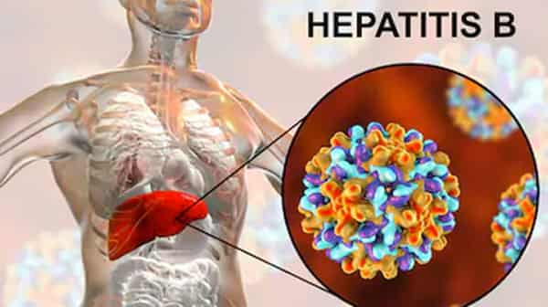 Hepatitis B