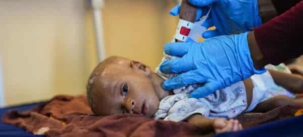 Horn of Africa Braces for ‘Explosion of Child Deaths’ as Hunger Crisis Deepens