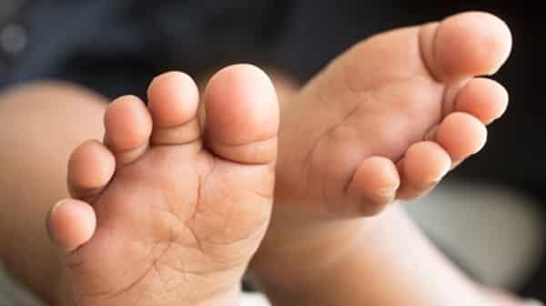 Down-Syndrome-722×406