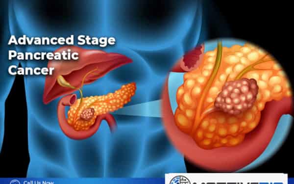 pancreatic-cancer