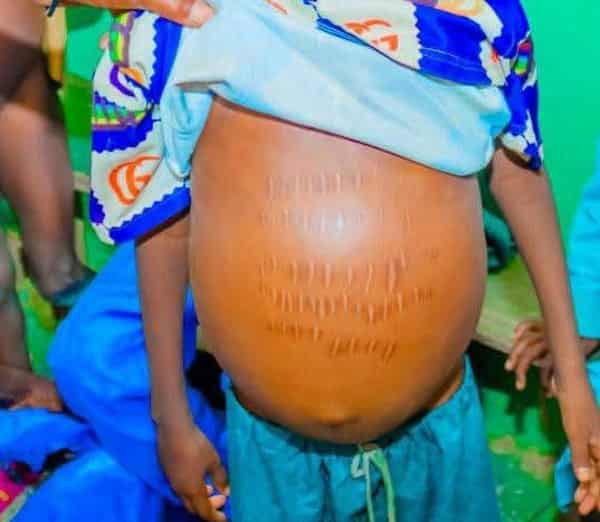 Patient of suspected metal poisoning in Sokoto