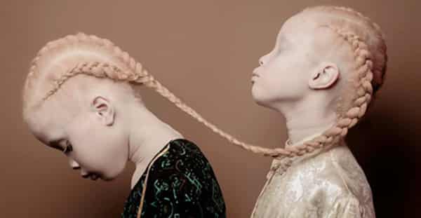 Albino-twins.-Photo-Noizz-e1560685258550