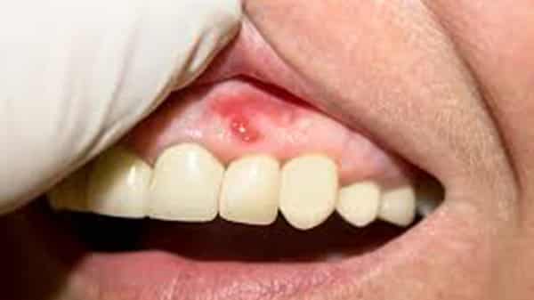 Gum disease