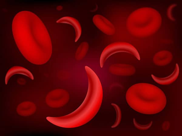 Sickle Cell