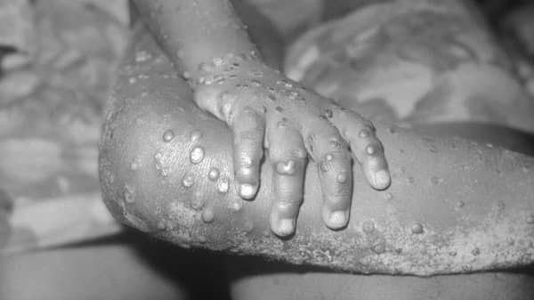 Monkeypox. [FILES] Increased disease surveillance across board has become urgently necessary as the Texas U.S. health authorities detect a monkeypox case traceable to Nigeria. Photo/