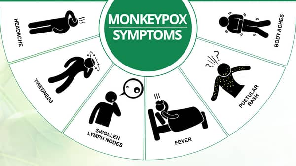 MONKEYPOX-SYMPTOMS