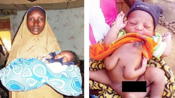 Baby_born_with_4_hand