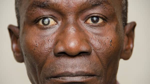 cataracts1 black blind man