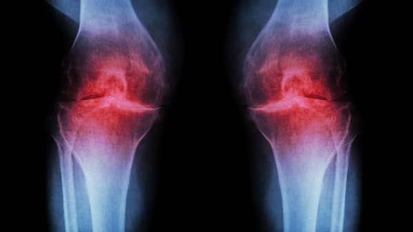 osteoarthritis