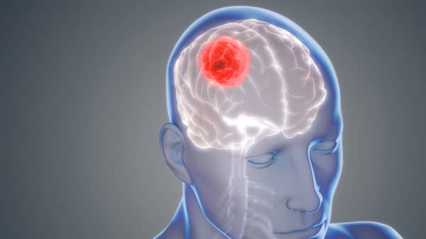 Brain Cancer(Glioblastoma)