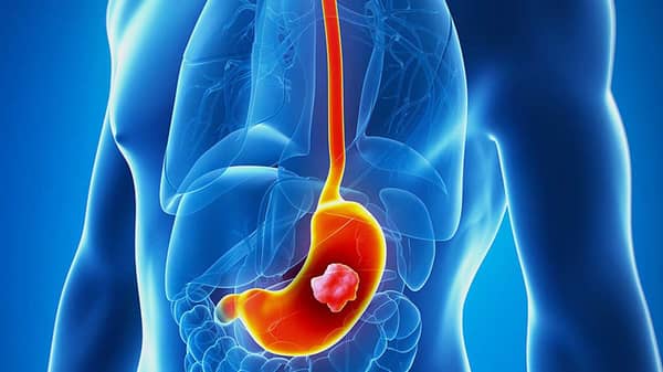 stomach-cancer