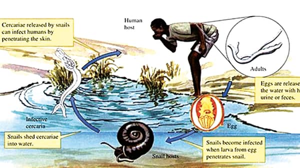 schistosomiasis