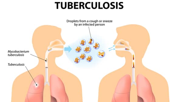 Tuberculosis