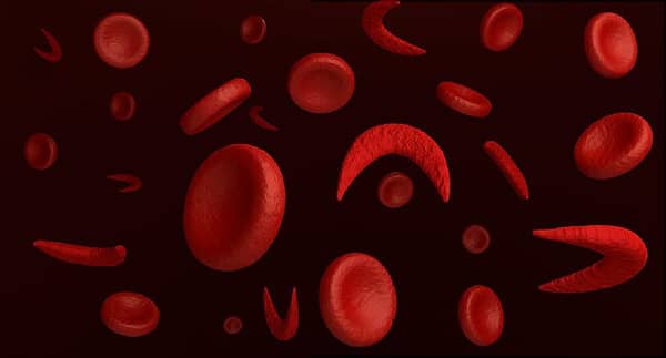 sickle cell