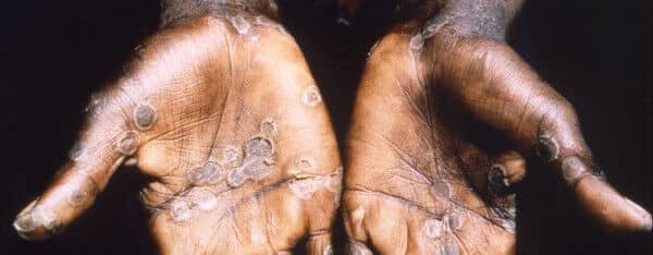 Monkeypox: How it Spreads, Who’s at Risk – Here’s What You Need to Know