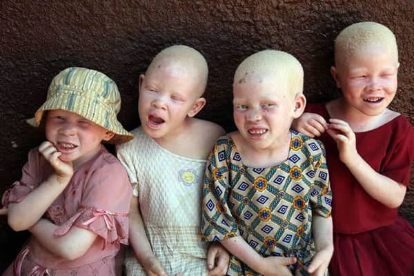 Albinism