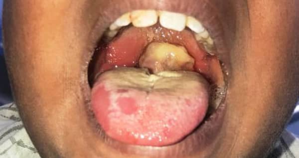 Diphtheria-patient-515×290