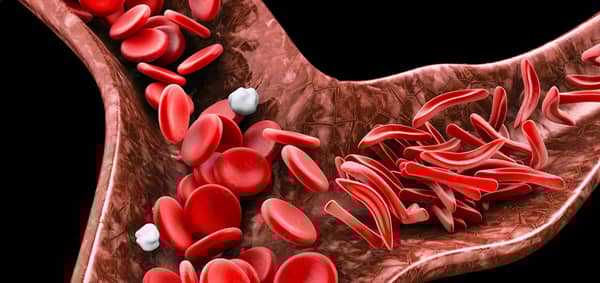 abc_sicklecell_scago