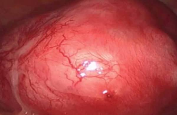 Laparoscopic-image-of-the-uterus-with-adenomyosis.