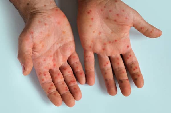 Germany-Detects-First-Case-Of-New-Mpox-Variant