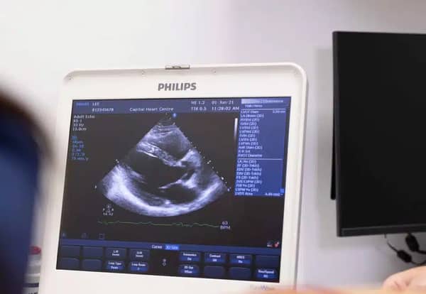 echocardiography