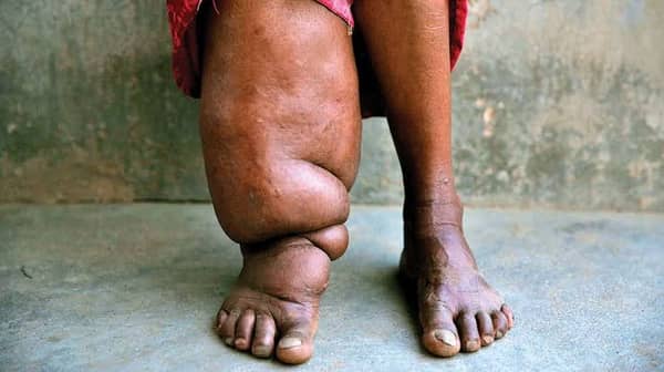 Lymphatic-Filariasis-Elephantiasis