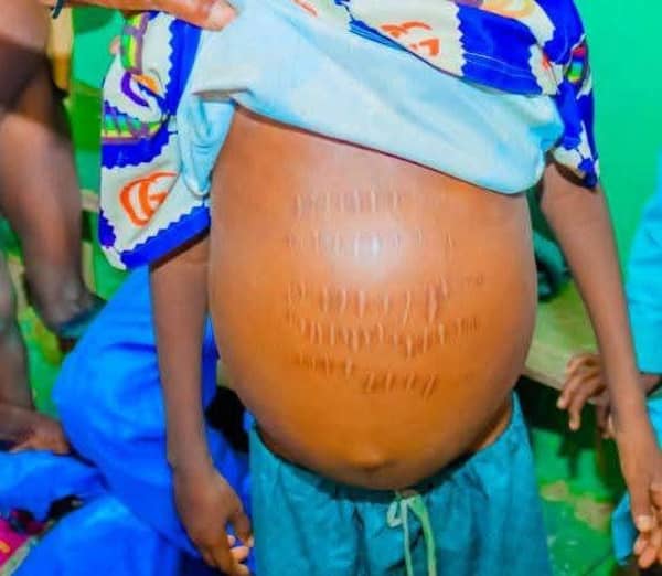 Patient of suspected metal poisoning in Sokoto