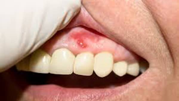 Gum disease