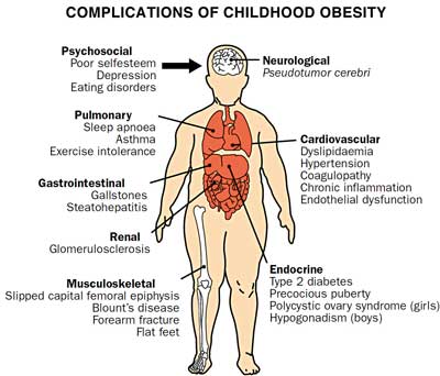 Childhood-obesity-complications