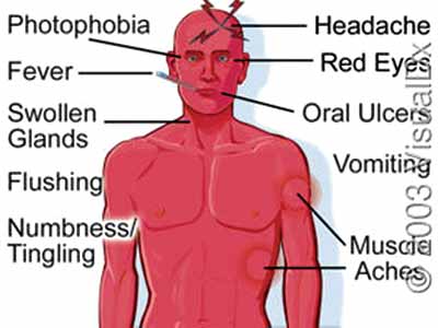 Symptoms of Lassa fever                                                  PHOTOS CREDIT: google.com/search