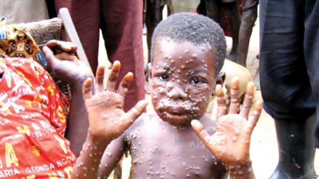 Failure to diagnose monkey pox exposes Nigeria’s poor lab capacity