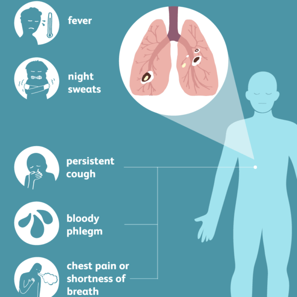 Understanding Tuberculosis | The Guardian Nigeria News - Nigeria and ...