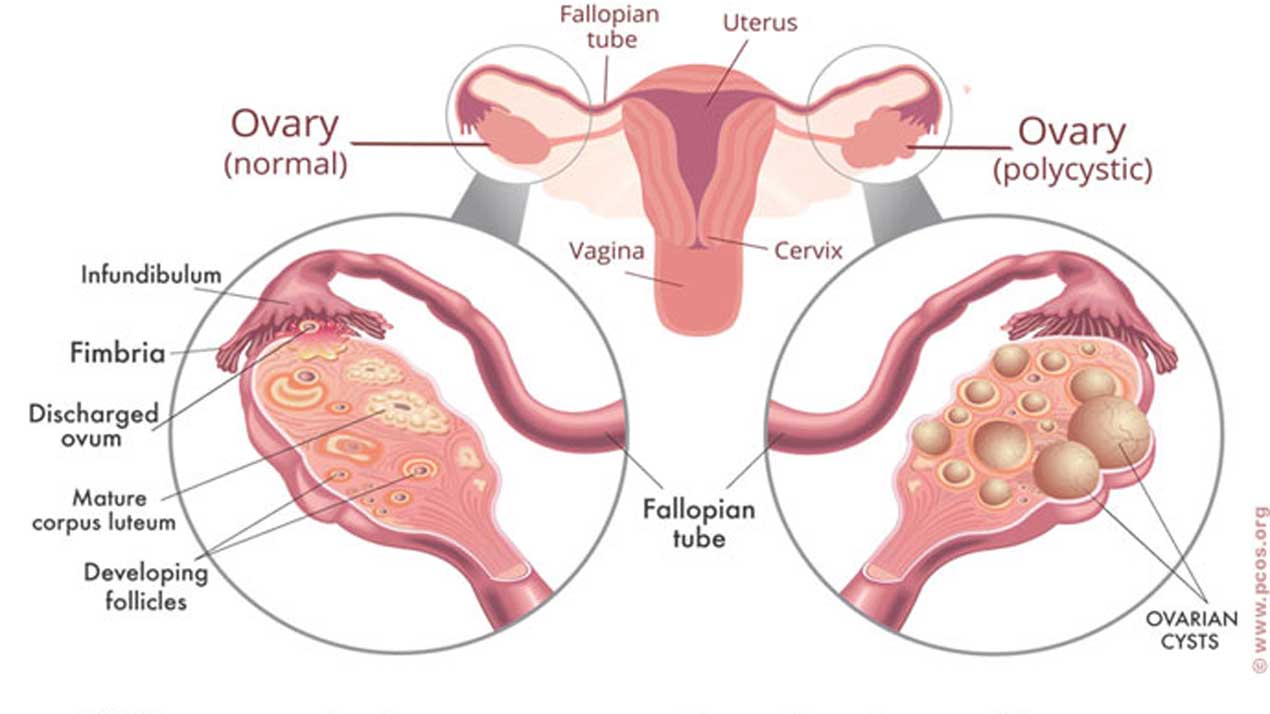 Knowing Polystic Ovarian Syndrome Pcos The Guardian Nigeria News Nigeria And World Newsfeatures The Guardian Nigeria News Nigeria And World News