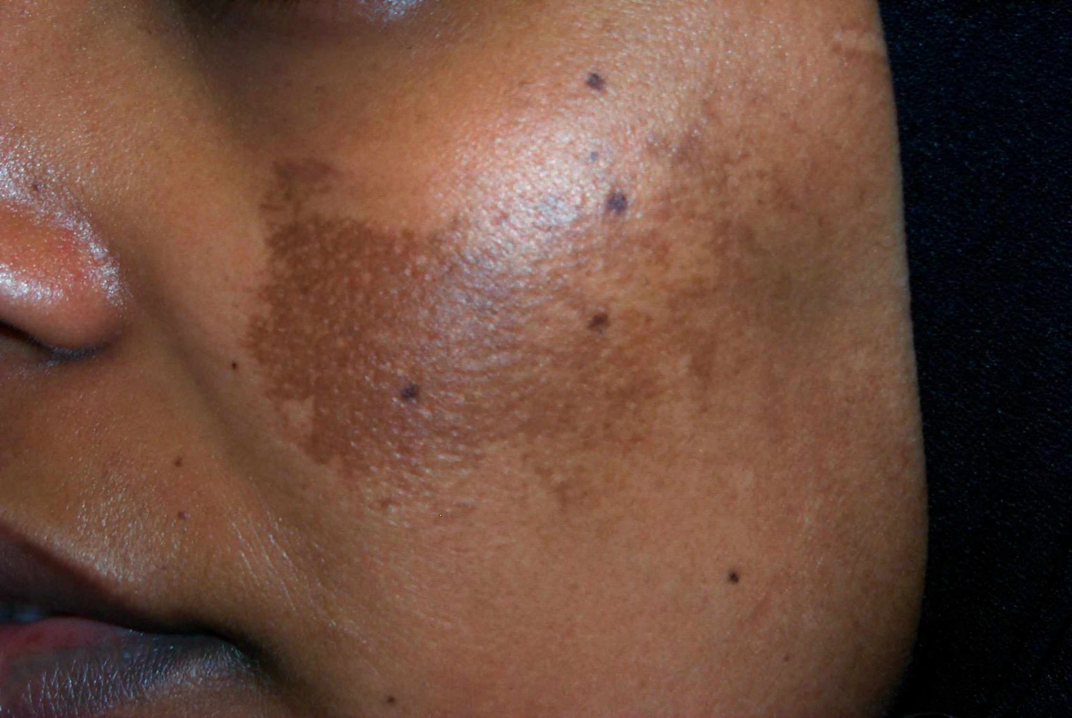 treating-melasma-in-pregnancy-the-self-care-guide-guardian-life