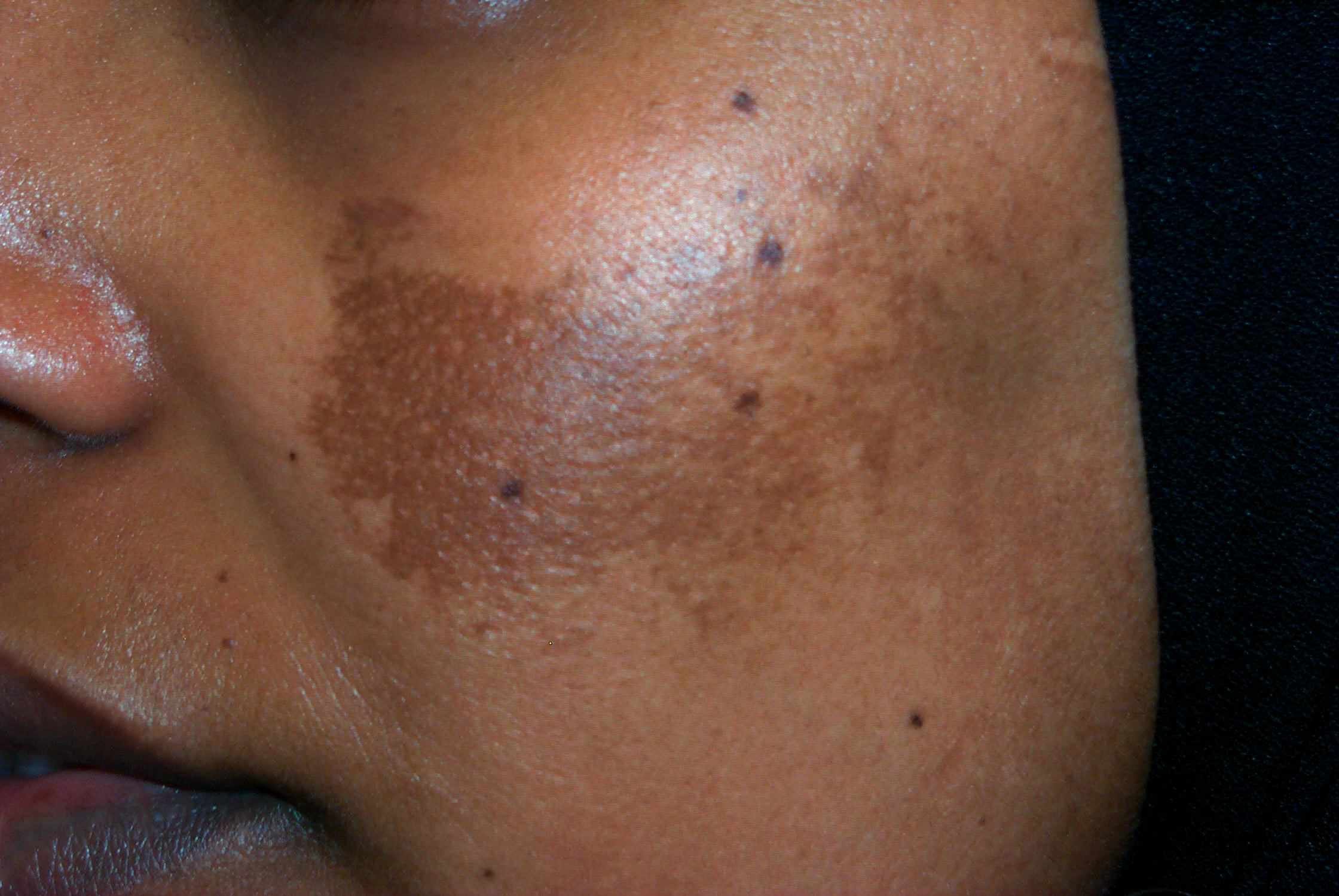 Does Pregnancy Cause Dark Spots On Face