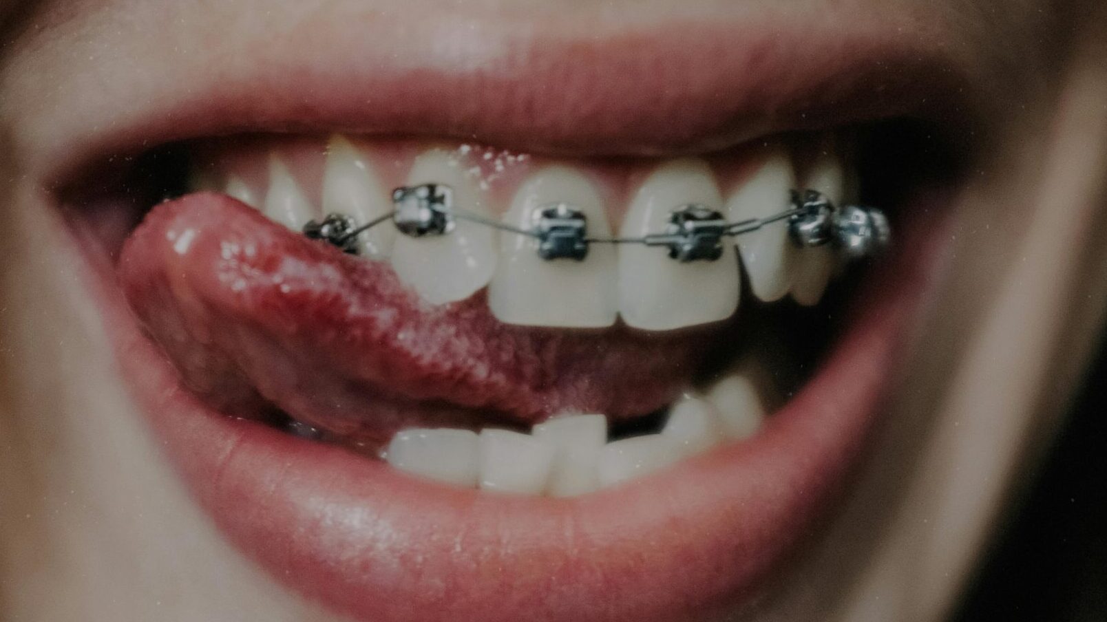 Dental braces